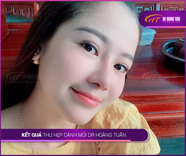 Hình ảnh kết quả thu gọn cánh mũi 